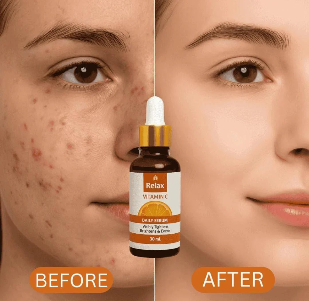 Before and after comparison of a face with acne treatment serum, featuring the 'Relax' brand.