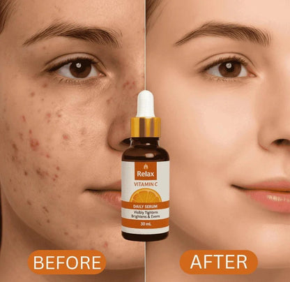 Before and after comparison of a face with acne treatment serum, featuring the 'Relax' brand.